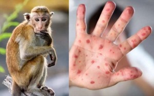 Các biện pháp phòng, chống bệnh đậu mùa khỉ